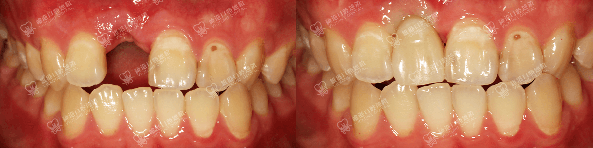 深圳種牙&深圳維港口腔