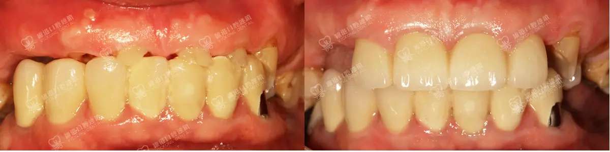 深圳種牙&深圳維港口腔