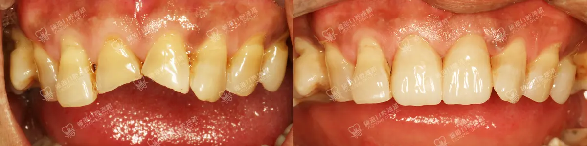 深圳種牙&深圳維港口腔