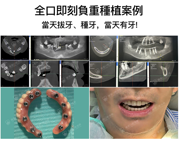 全口即刻負重