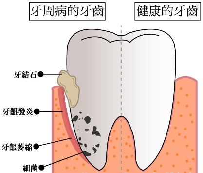 深圳牙周治療