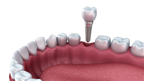 深圳维港口腔种植牙