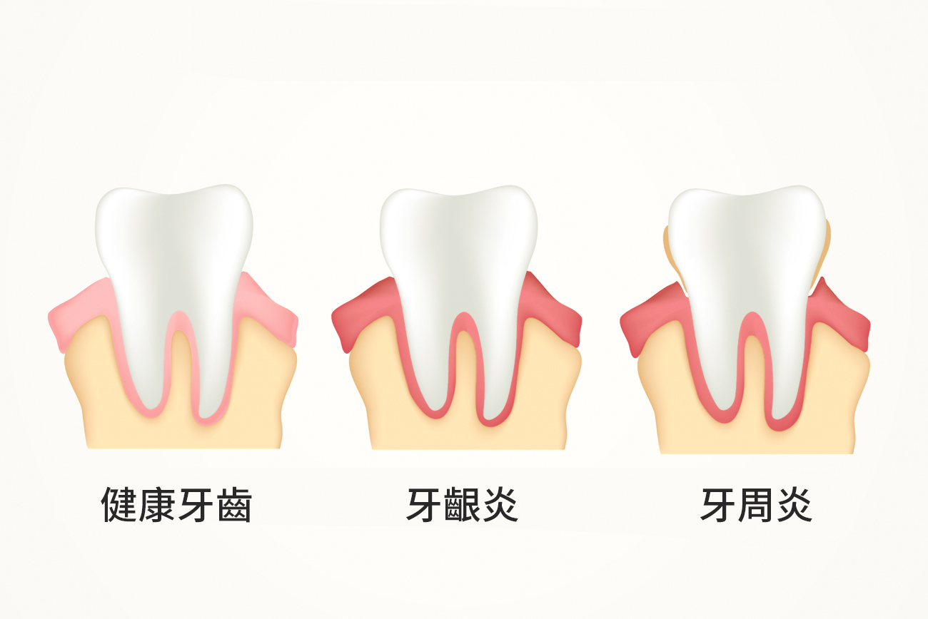 牙周炎