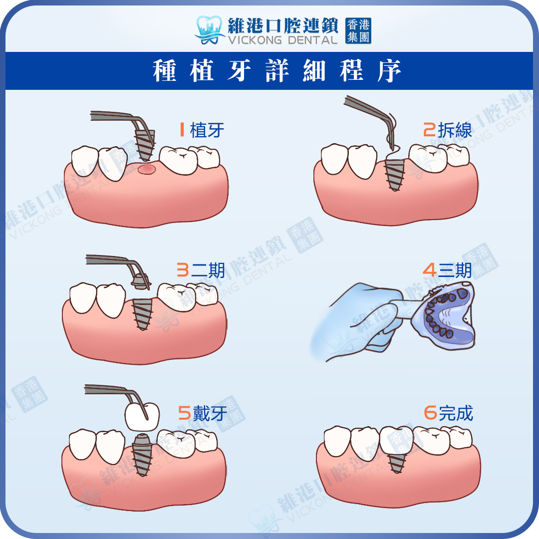 維港口腔植牙流程