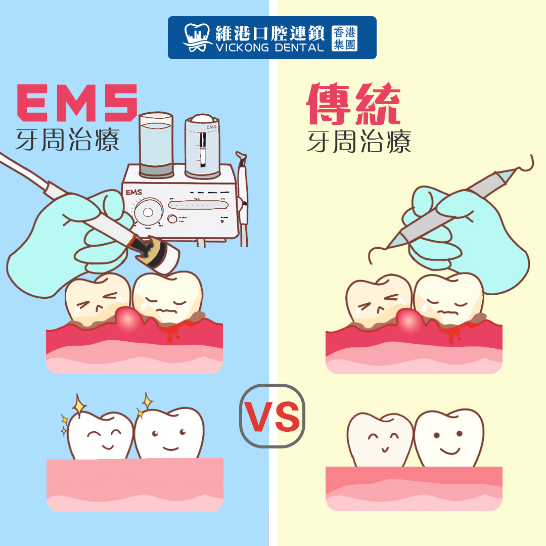 EMS牙周治療