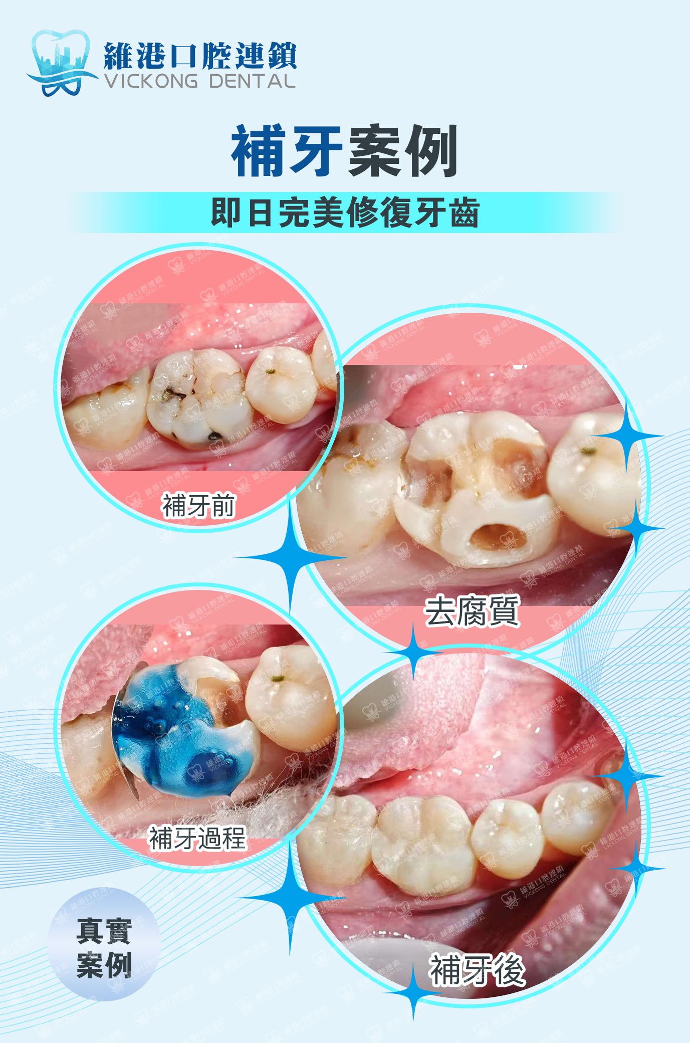 深圳補牙