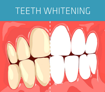 牙齒美白 牙齒美白