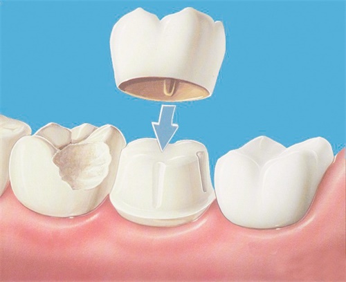 牙冠图片 牙冠图片