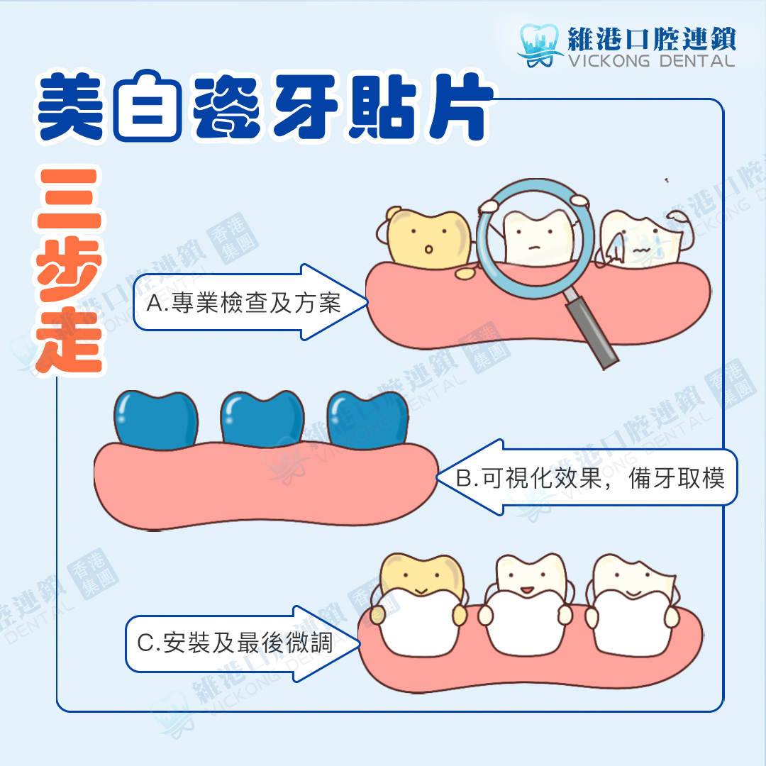 美白瓷牙贴片步骤 美白瓷牙贴片步骤