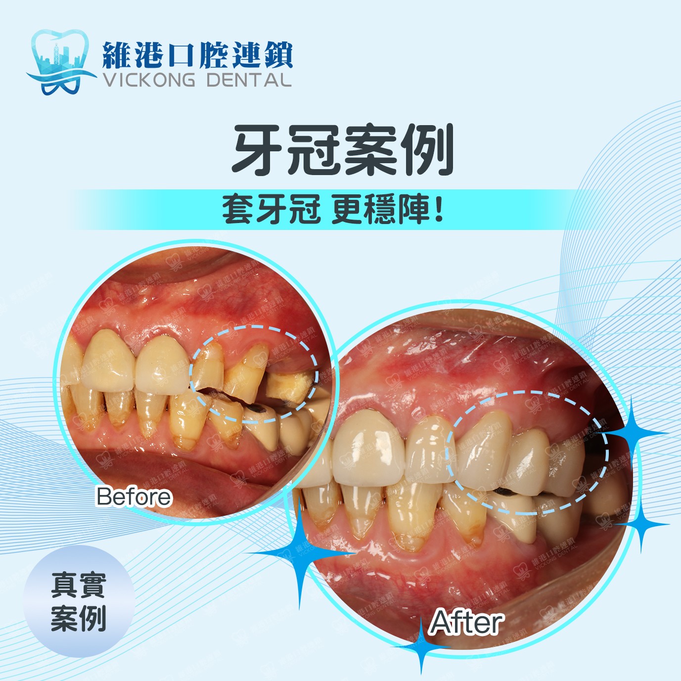 牙冠案例 牙冠案例